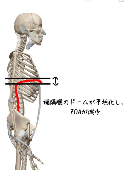 肋骨外旋位でのZOAの説明
