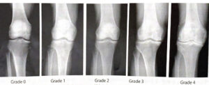 変形性膝関節症の分類